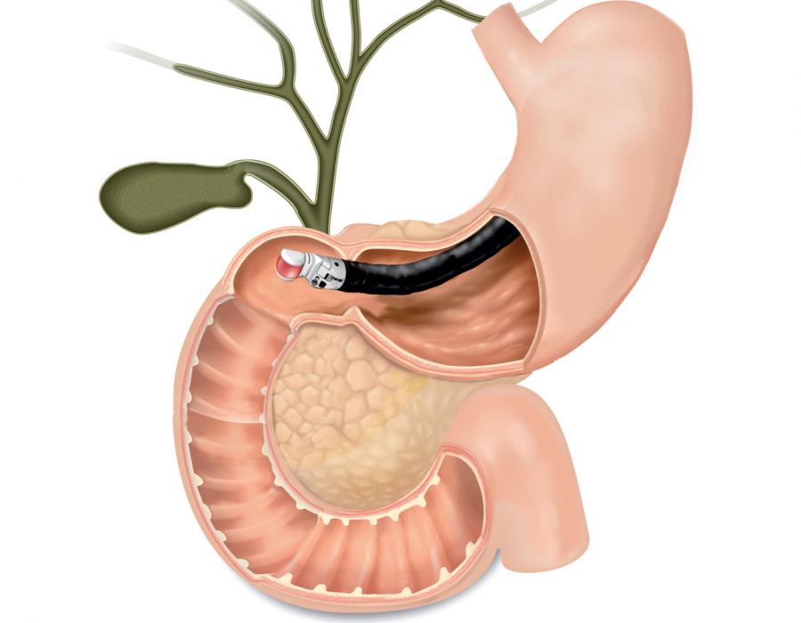 endoscopic-ultrasound-olympus-eus